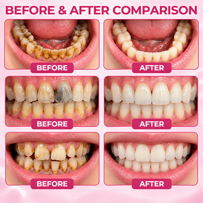 LUHAKA® DenPerm Cavity-Repair Gel