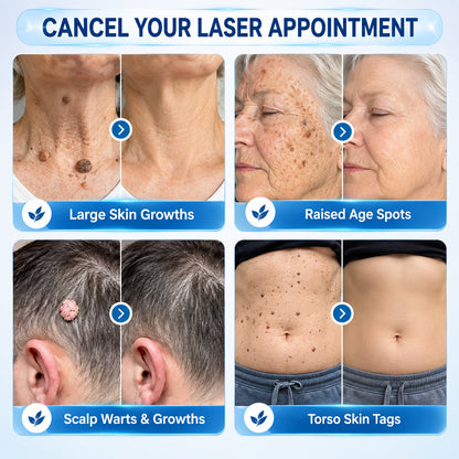 LUHAKA® Cream for Removing Skin Tags and Dark Spots