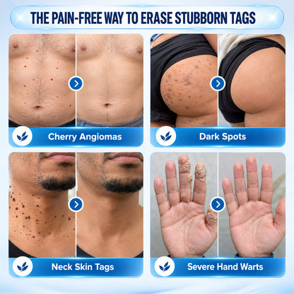 LUHAKA® Cream for Removing Skin Tags and Dark Spots